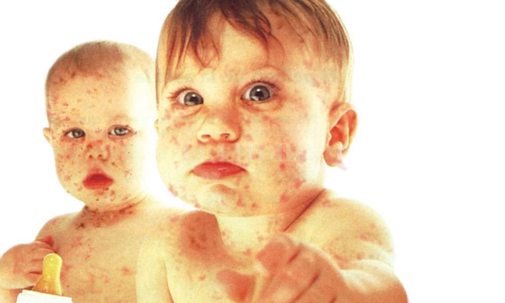Reforzarán la vacunación de niños Alerta por casos de sarampión - Alerta por casos de sarampión - -