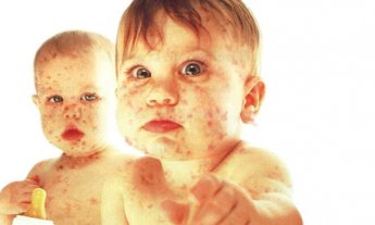 Alerta por casos de sarampión Alerta por casos de sarampión