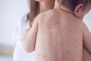 En 2020, ms de 22 millones de bebs no fueron vacunados contra el sarampin en todo el mundo
