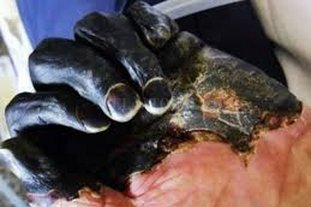 Viejo enemigo humano Brote de peste bubónica: ¿qué es "la peste negra" y a qué se debe? - Brote de peste bubónica: ¿qué es "la peste negra" y a qué se debe? -