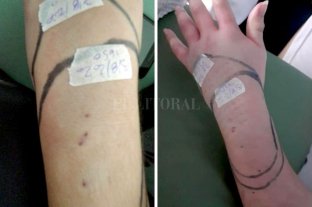 Una yarará "picó" dos veces en la mano a una mujer en la costanera Santo Tomé: advierten sobre la presencia de serpientes en el casco urbano - La mujer fue mordida por la yarará dos veces en la zona de la muñeca. Afortunadamente se recupera favorablemente. Santo Tomé: advierten sobre la presencia de serpientes en el casco urbano - La mujer fue mordida por la yarará dos veces en la zona de la muñeca. Afortunadamente se recupera favorablemente.