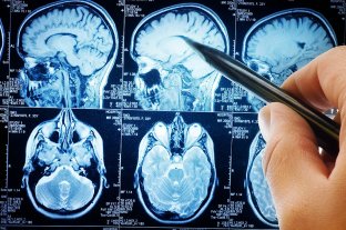 Efectos cognitivos El cerebro de algunos recuperados de coronavirus podría envejecer hasta 10 años - El cerebro de algunos recuperados de coronavirus podría envejecer hasta 10 años -